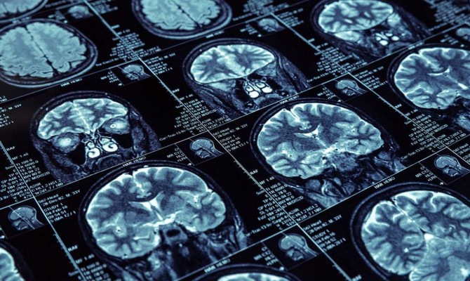 A series of brain scans